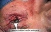 Ectropion Repair Lower Eyelid Post Over - Corrected Blepharoplasty