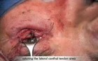 Ectropion Repair Lower Eyelid Post Over - Corrected Blepharoplasty