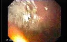 Gastric Adenocarcinoma With Varices - Endoscopy (5 of 8)