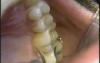 Micro Ultrasonic Teeth Celaning