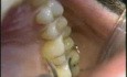 Micro Ultrasonic Teeth Celaning