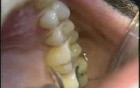 Micro Ultrasonic Teeth Celaning