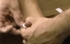 How To Tap Toe Fracture?