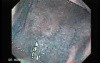 Multiple Irregular and Large Ulcers - Chromoendoscopy with Indigo Carmine Stain, Part 2
