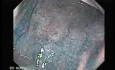 Multiple Irregular and Large Ulcers - Chromoendoscopy with Indigo Carmine Stain, Part 2