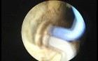 Prostate TUVis