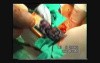 Esophagectomy - Esophageal Cancer Surgery