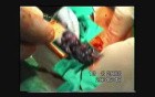 Esophagectomy - Esophageal Cancer Surgery