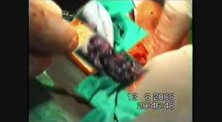 Esophagectomy - Esophageal Cancer Surgery
