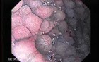 Follicular Lymphoid Hyperplasia (4 of 4)
