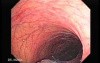 Huge Mass Of The Descending Colon (18 of 25)
