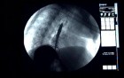 Esophageal Stenting - Fluoroscopic View