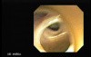 Choledocoduodenostomy and The Sump Syndrome (9 of 10)