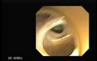 Choledocoduodenostomy and The Sump Syndrome (9 of 10)