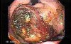 Upper Gastrointestinal Tract - Bleeding (7 of 7)