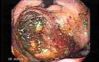 Upper Gastrointestinal Tract - Bleeding (7 of 7)