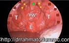 Paediatric Obstructive Sleep Apnea Syndrome (OSA) - Significantly Elongated Uvula and Obstructive Adenoid