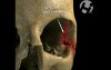 Volumated Facial Fractures