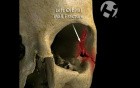 Volumated Facial Fractures