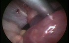 Adnexal Torsion - Diagnosis and Treatment - Sixteen Years Old Woman