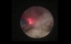 Retrograde Intrarenal Surgery - Ureteropelvic Junction Stone