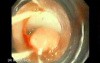 Upper GI Bleeding Due to Esophageal Varices - Banding
