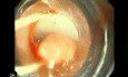 Upper GI Bleeding Due to Esophageal Varices - Banding