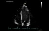 Calculation of Left Ventricle Ejection Fraction