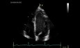 Calculation of Left Ventricle Ejection Fraction