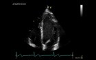 Calculation of Left Ventricle Ejection Fraction
