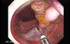 Colonoscopic Polypectomy (9 of 29)
