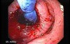 Esophagus - Pneumatic Dilation for Achalasia - Status Post Dilation