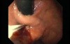 Gastric Varices - Endoscopic Ablation With Cyanoacrylate Glue (7 of 18)
