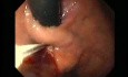 Gastric Varices - Endoscopic Ablation With Cyanoacrylate Glue (7 of 18)