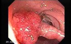 Endoscopic Appearance of Pedicled Polyp of the Descending Colon (3 of 7)