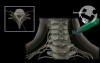 Epidural Steroid Injection