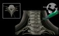 Epidural Steroid Injection