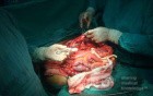 Mesenteric Ischemia (6 of 12)