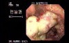 Gastric Adenocarcinoma With Central Necrosis - Endoscopy