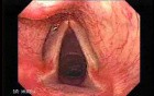 Laryngopharyngeal and Gastroesophageal Reflux