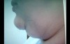 Double chin - plastic surgery