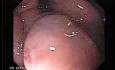 Large Gastric Varices (1 of 4)