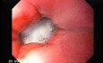 Intragastric Balloon - The Treatment Of Obesity (13 of 13)