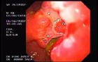 Ulcerative Gastric Carcinoma - Endoscopy