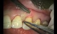 Periodontal Microsurgery: AlloDerm Grafting