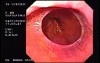 Hiatus Hernia with Schatzki Ring.