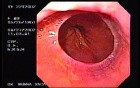 Hiatus Hernia with Schatzki Ring.
