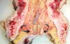 Rectal Adenocarcinoma (5 of 7)