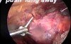 VATS- thymectomy anatomy