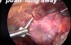 VATS- thymectomy anatomy